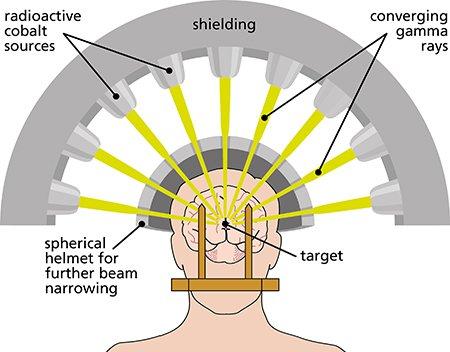 Stereotactic Radiosurgery